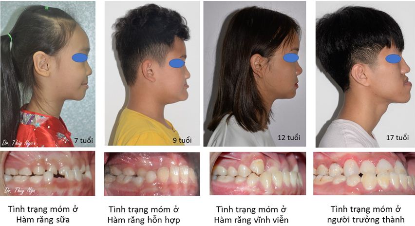 Các tình trạng răng móm khác nhau